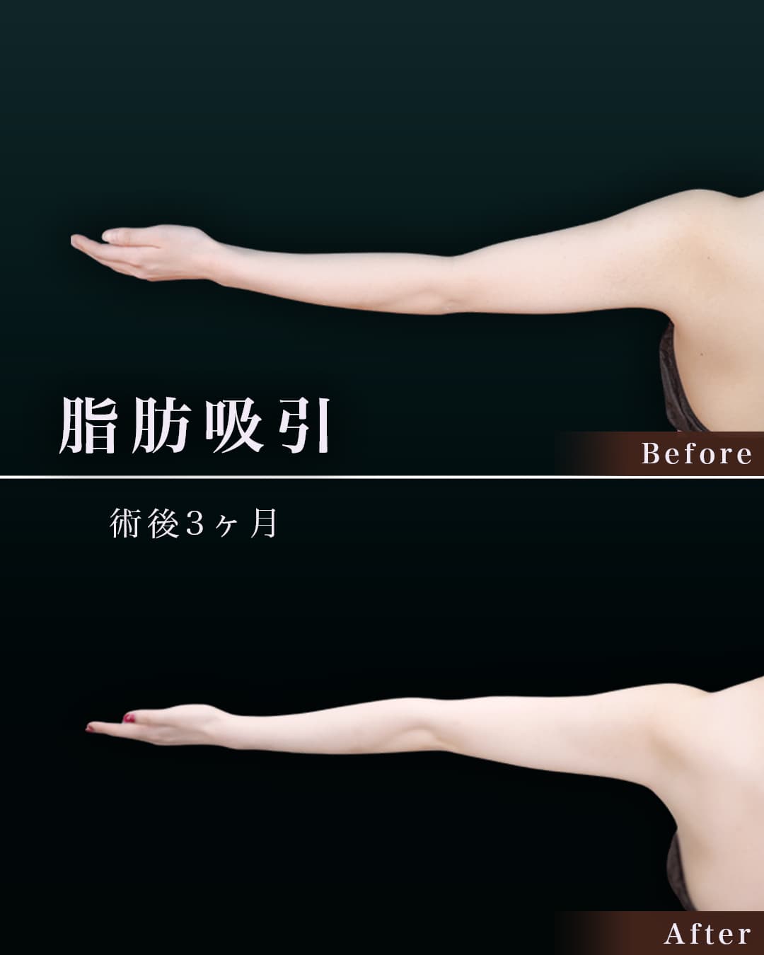 165㎝49㎏20代 上腕・肩、付け根 術後3か月の症例写真