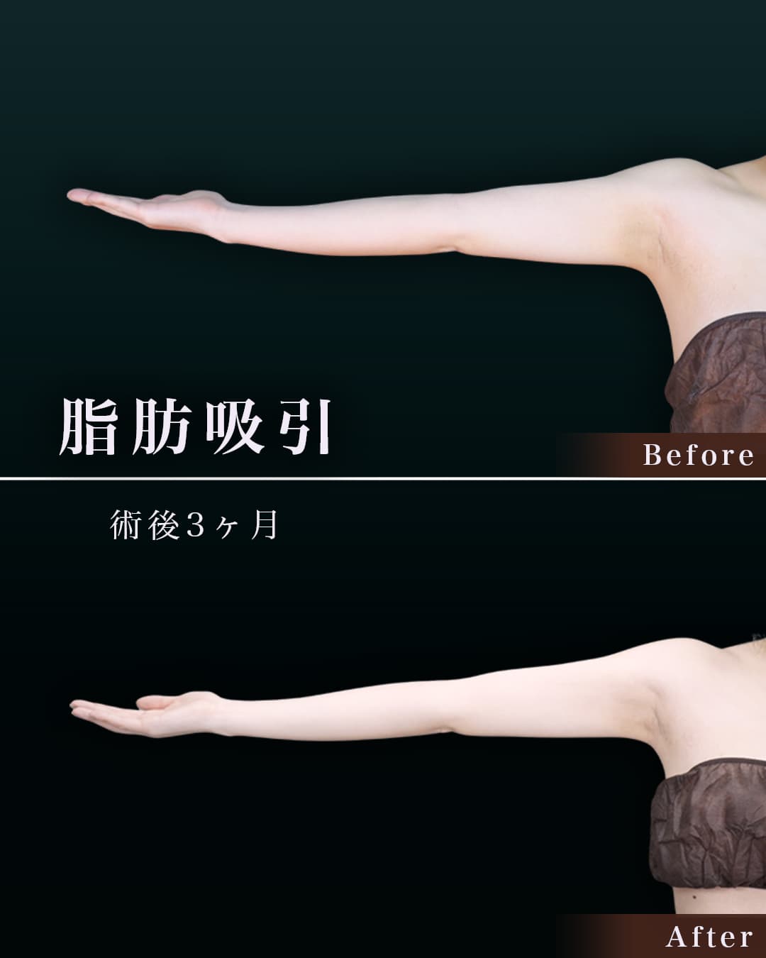 165㎝49㎏20代 上腕・肩、付け根 術後3か月の症例写真