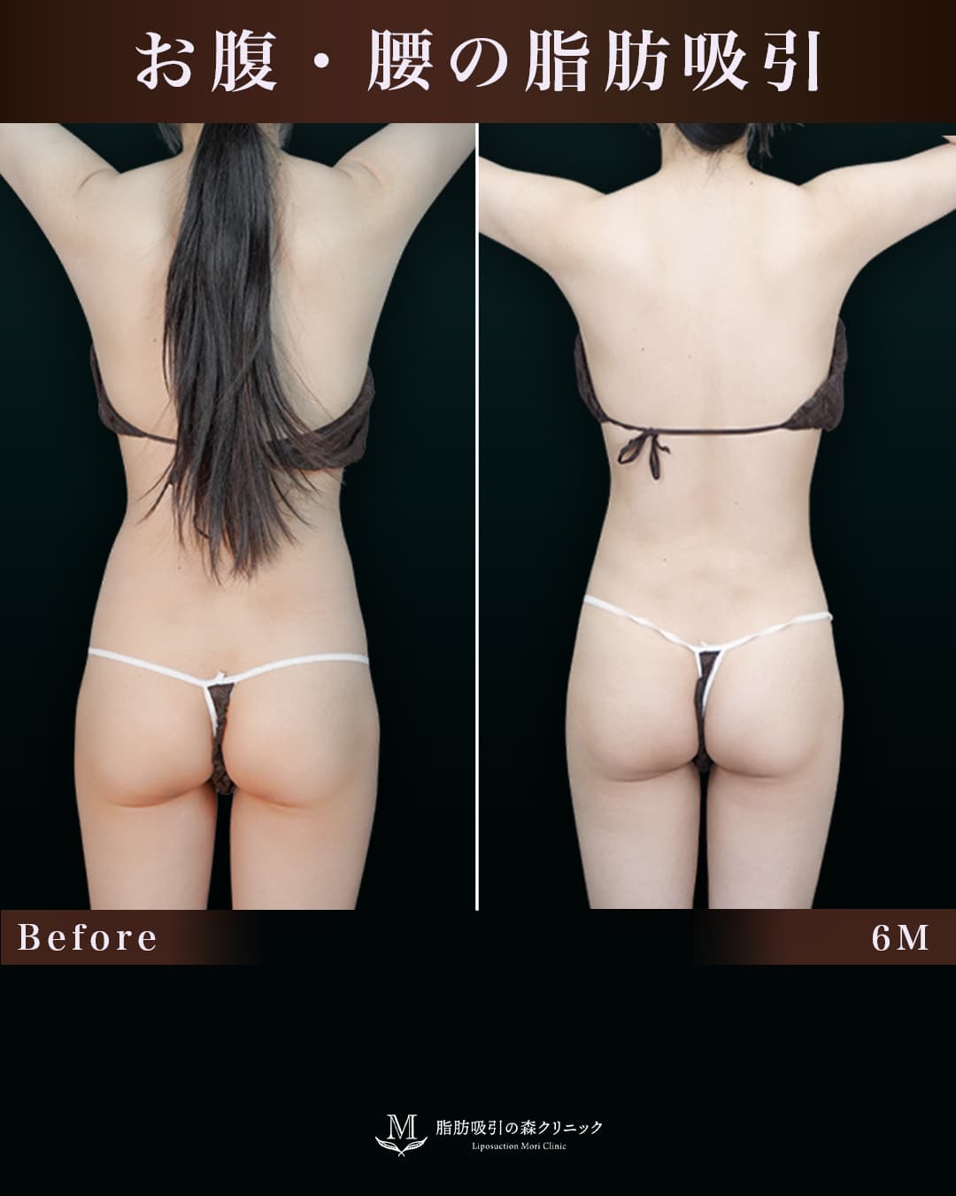 165㎝49㎏20代 胸下・腹部全体・腰 術後6か月の症例写真