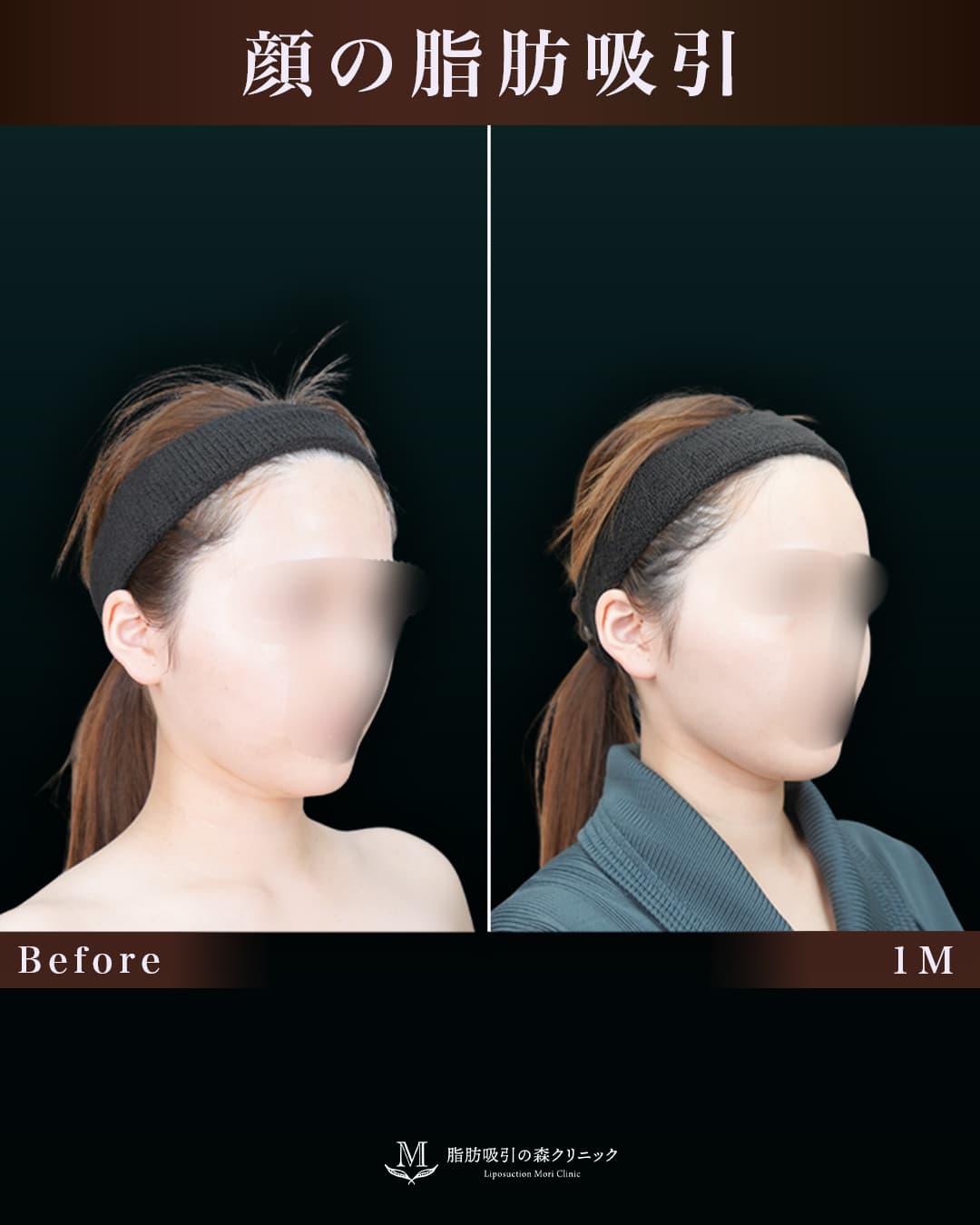 152㎝47㎏20代 顎下 術後1か月の症例写真