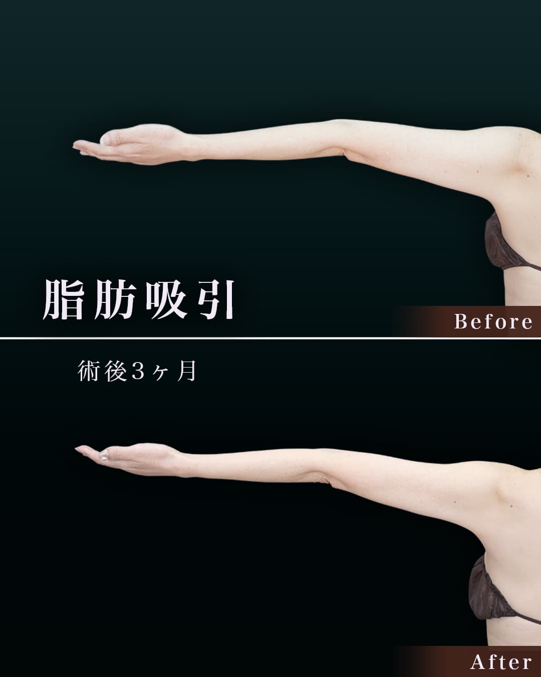163㎝51㎏50代 上腕・肩、付け根 術後3か月の症例写真