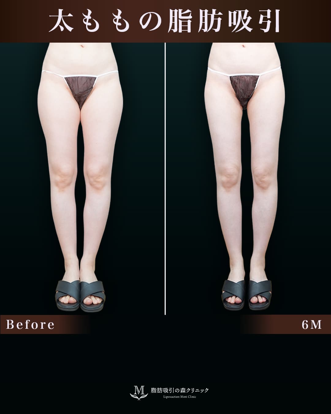 164㎝56㎏30代 大腿全周・膝・臀部 術後6か月の症例写真