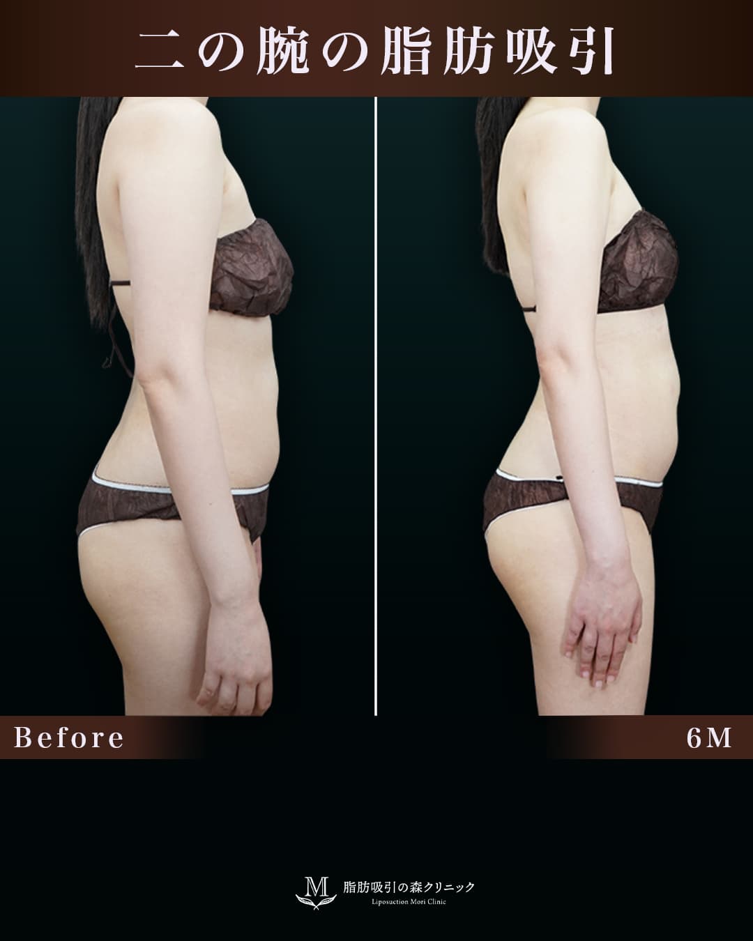 165㎝61㎏30代 上腕全周、脇肉、付け根 術後6か月の症例写真