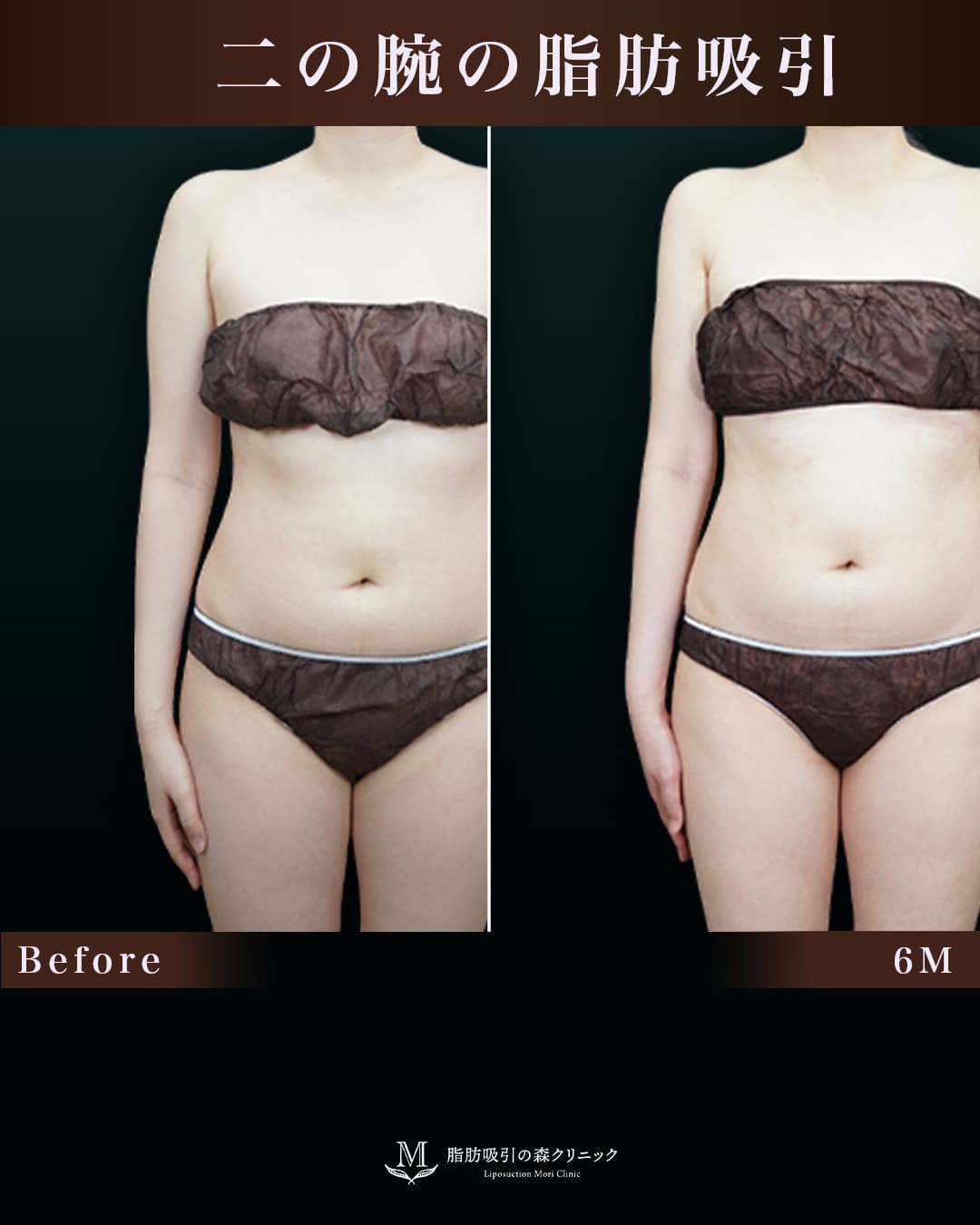 165㎝61㎏30代 上腕全周、脇肉、付け根 術後6か月の症例写真