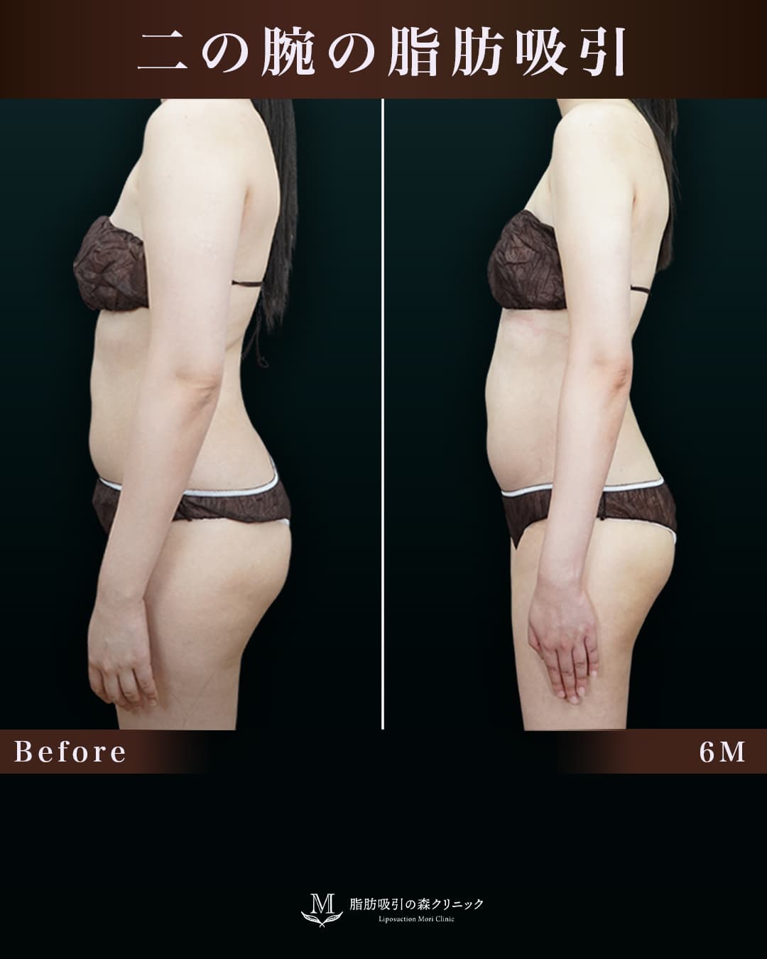 165㎝61㎏30代 上腕全周、脇肉、付け根 術後6か月の症例写真