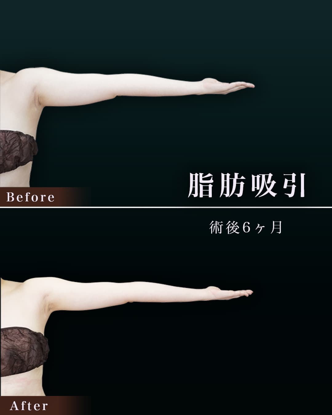 165㎝61㎏30代 上腕全周、脇肉、付け根 術後6か月の症例写真