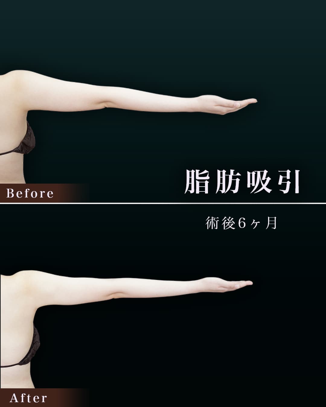 165㎝61㎏30代 上腕全周、脇肉、付け根 術後6か月の症例写真