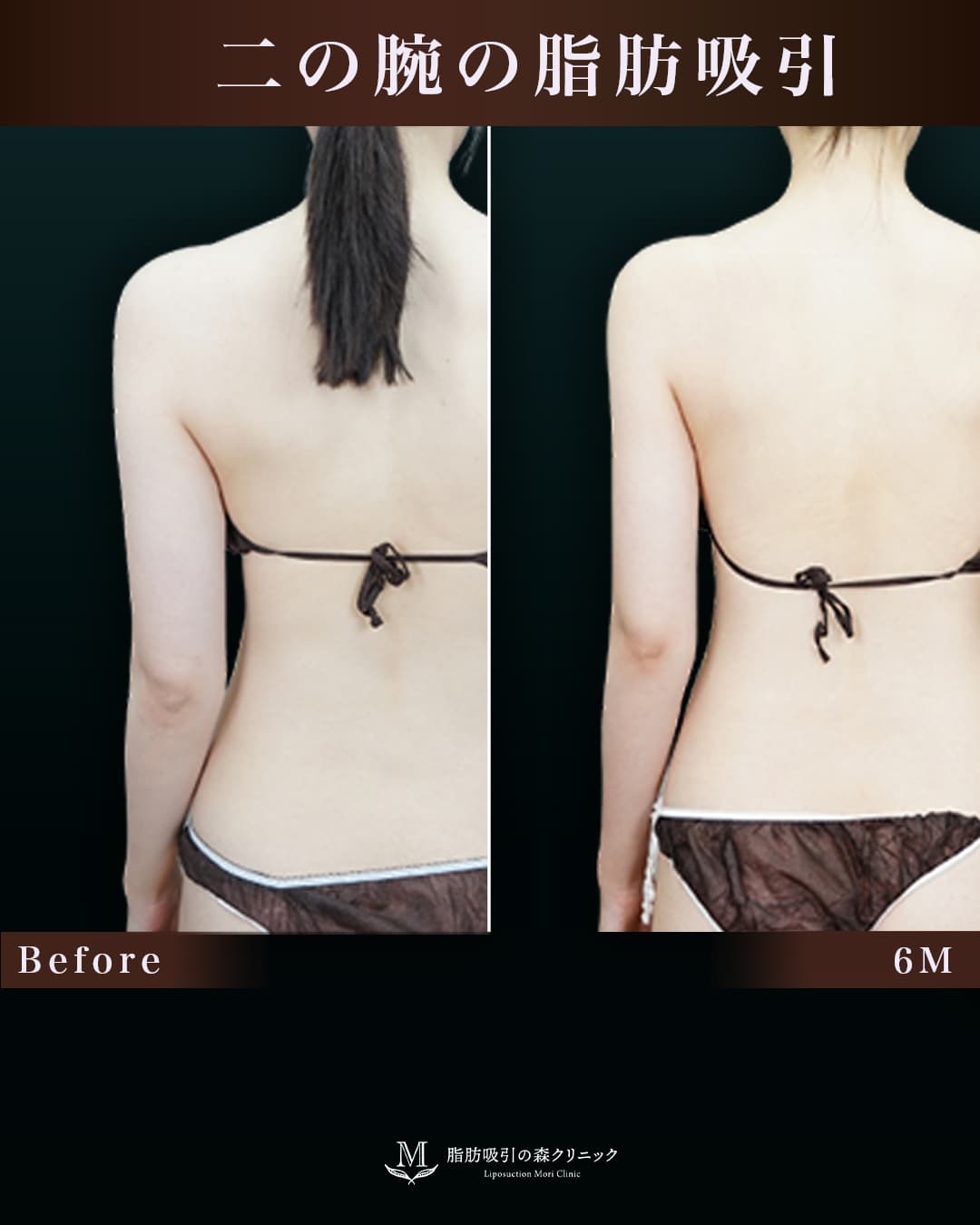170㎝60㎏20代 上腕全周、脇肉、付け根 術後6か月の症例写真