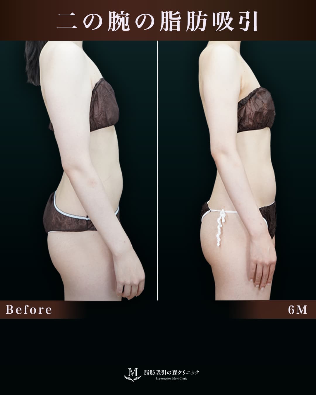 170㎝60㎏20代 上腕全周、脇肉、付け根 術後6か月の症例写真