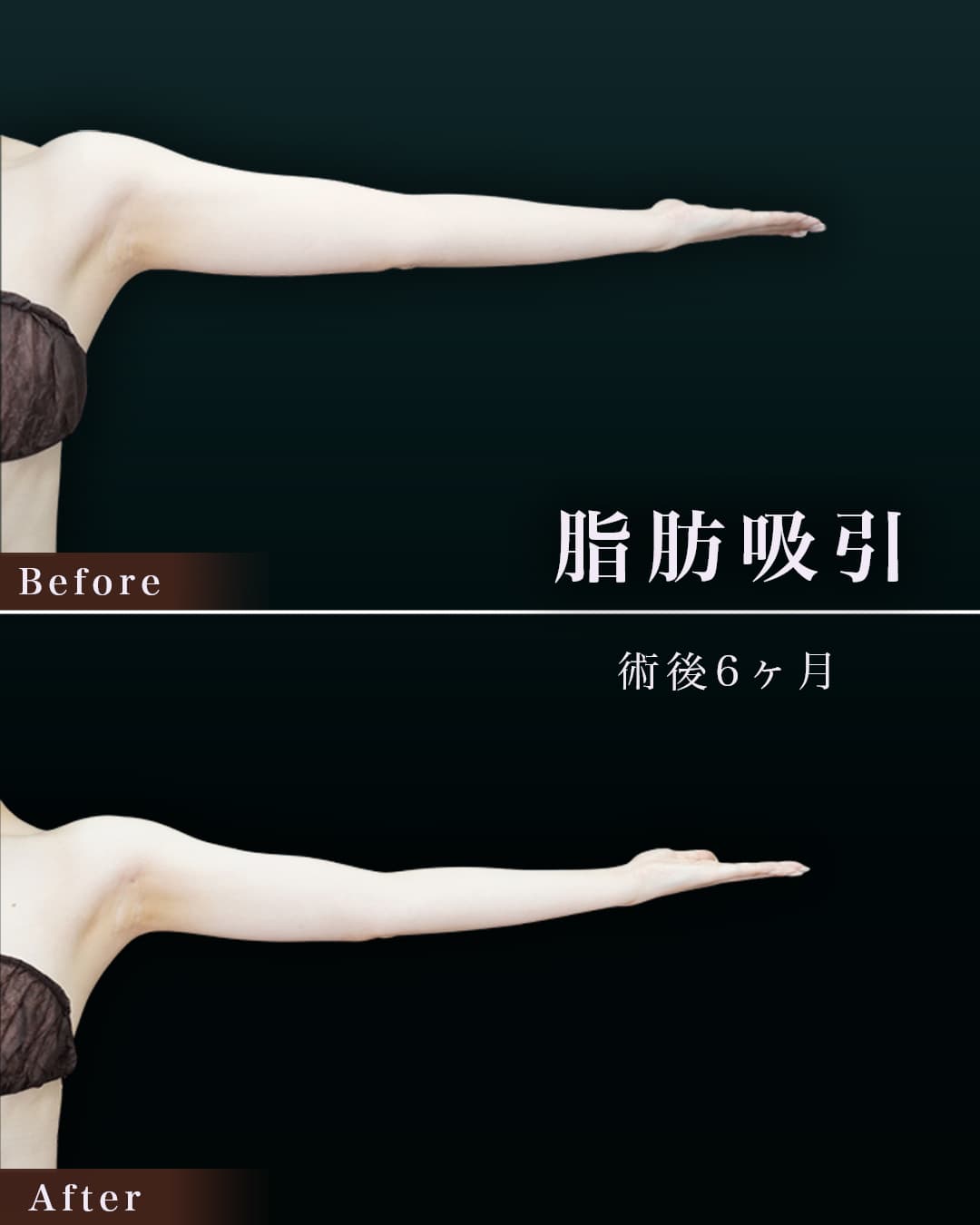 170㎝60㎏20代 上腕全周、脇肉、付け根 術後6か月の症例写真