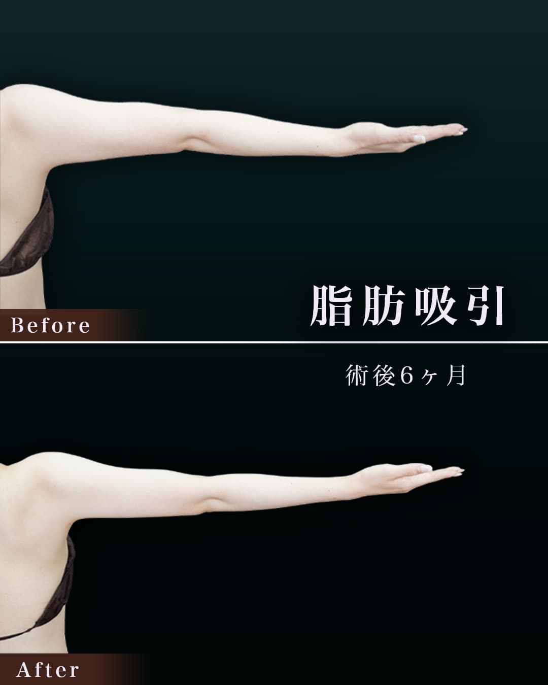 170㎝60㎏20代 上腕全周、脇肉、付け根 術後6か月の症例写真