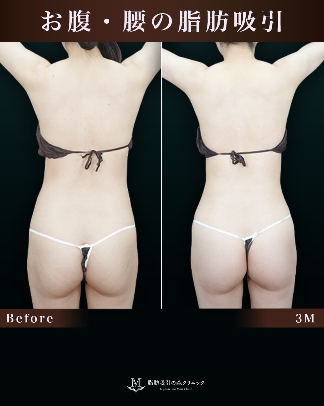 163㎝52㎏20代 腹部全体・腰 術後3か月の症例写真