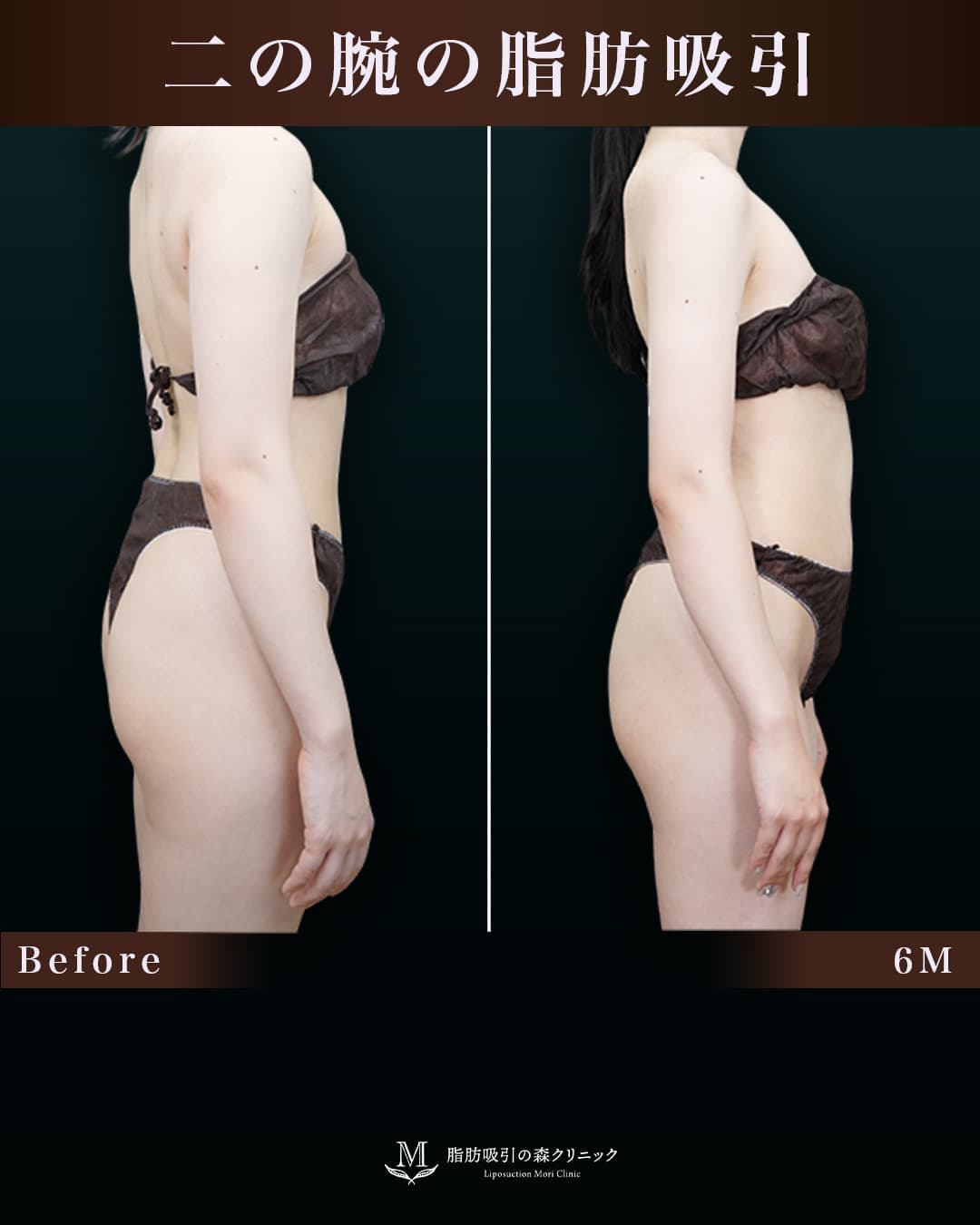 158㎝53㎏20代 上腕・肩、付け根 術後6か月の症例写真