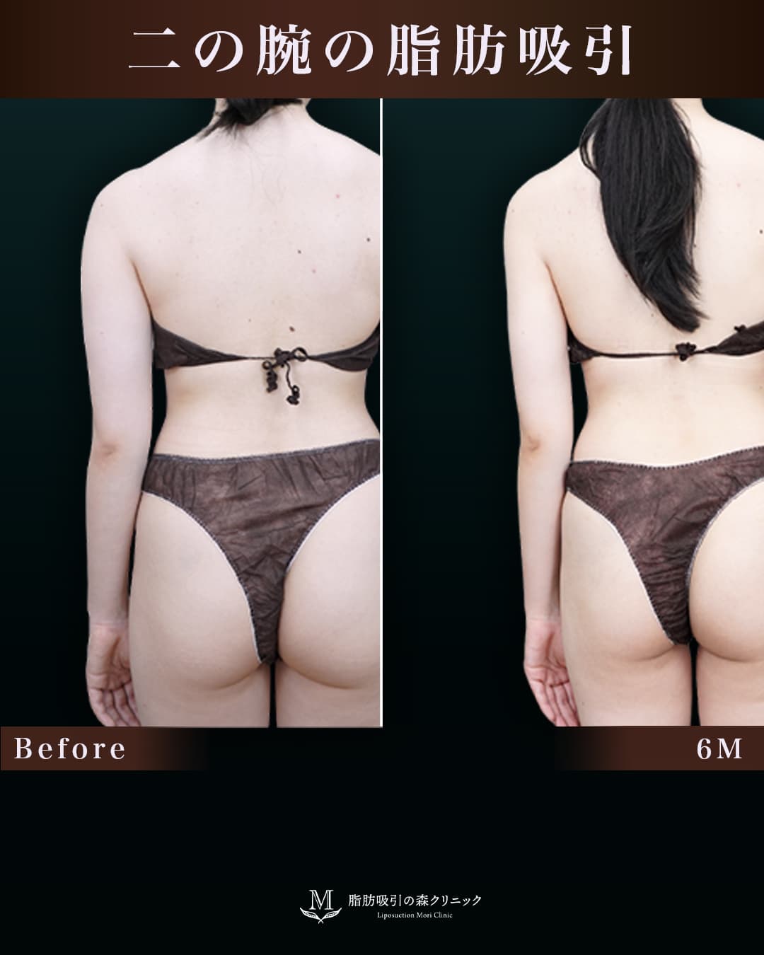 158㎝53㎏20代 上腕・肩、付け根 術後6か月の症例写真