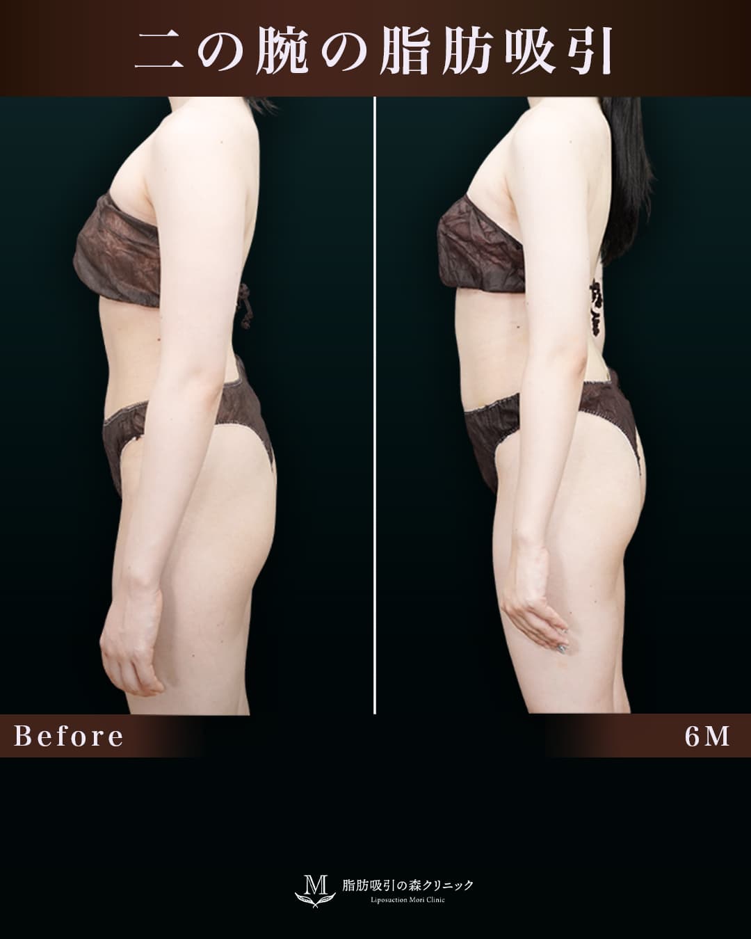 158㎝53㎏20代 上腕・肩、付け根 術後6か月の症例写真