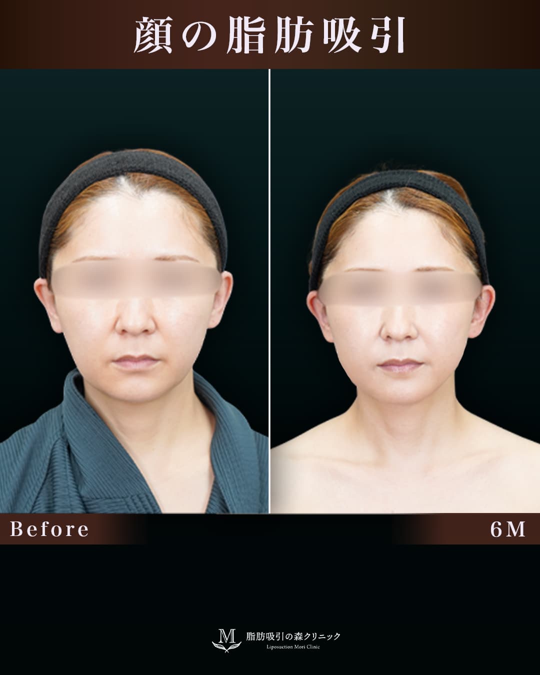154㎝42㎏30代 頬+顎下、糸リフト 術後6か月の症例写真