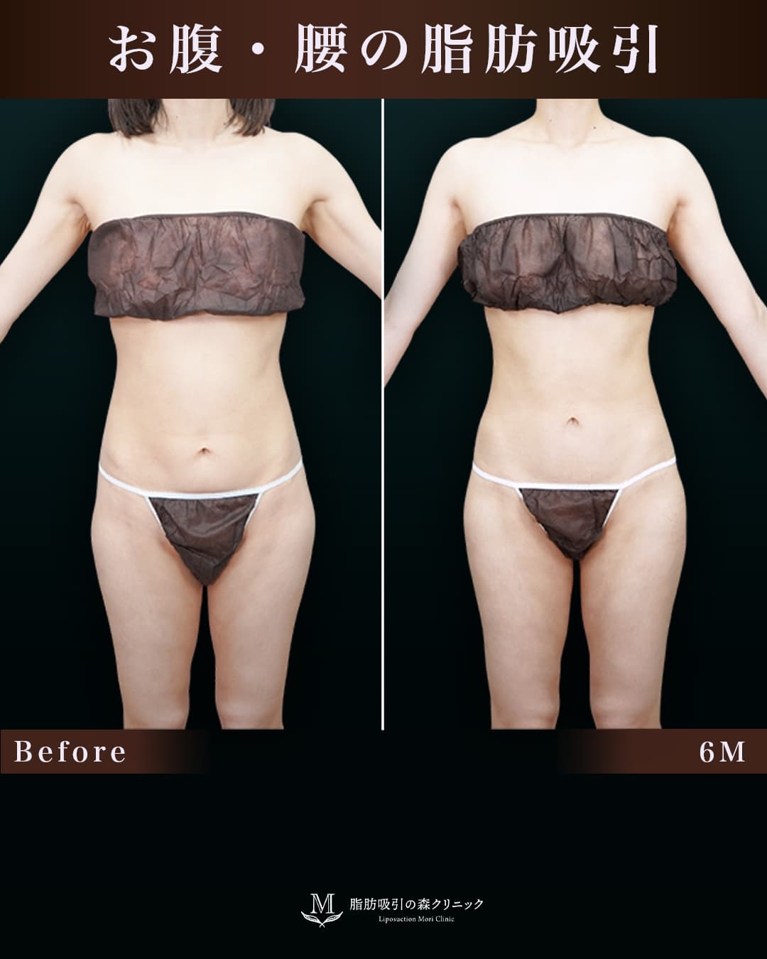 153㎝43㎏20代 胸下・腹部全体・腰 術後6か月の症例写真