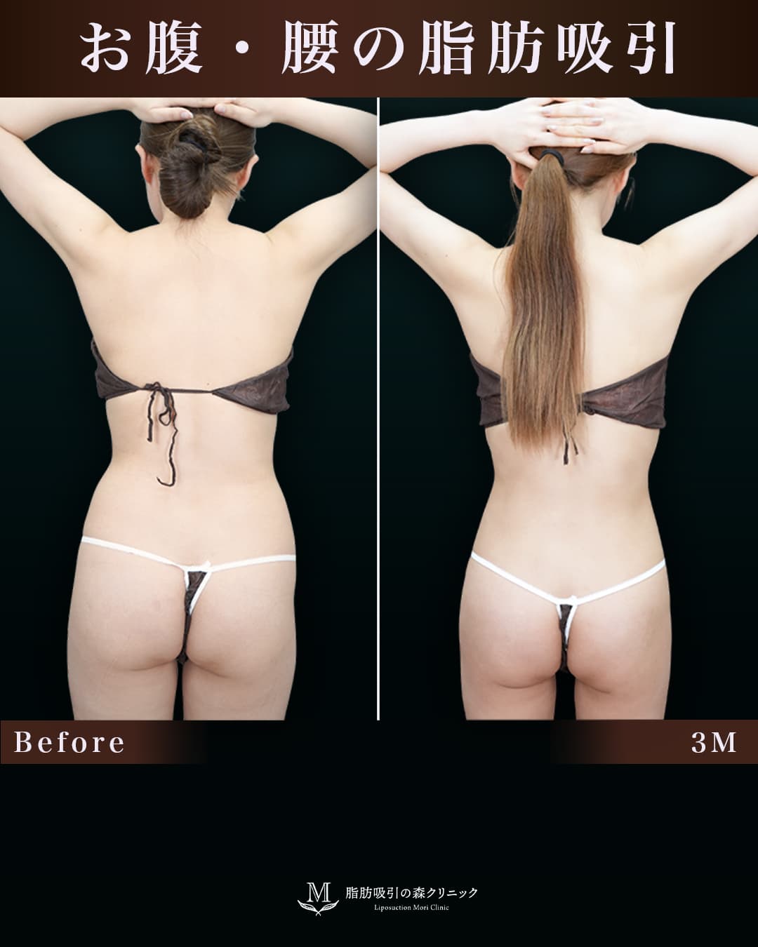 152㎝49㎏30代 胸下・腹部全体・腰 術後3か月の症例写真