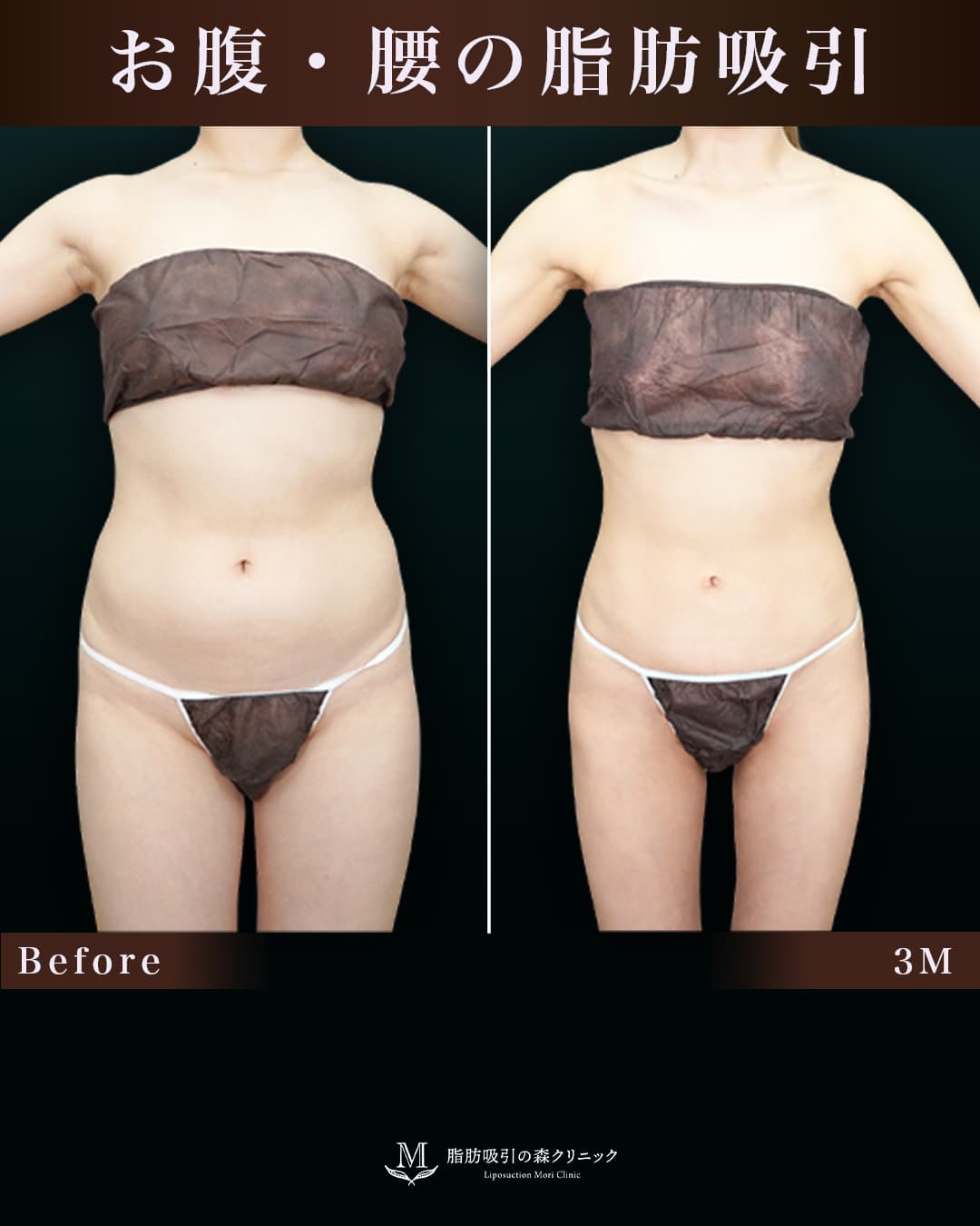 152㎝49㎏30代 胸下・腹部全体・腰 術後3か月の症例写真