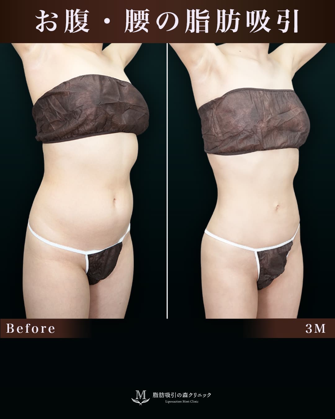 152㎝49㎏30代 胸下・腹部全体・腰 術後3か月の症例写真