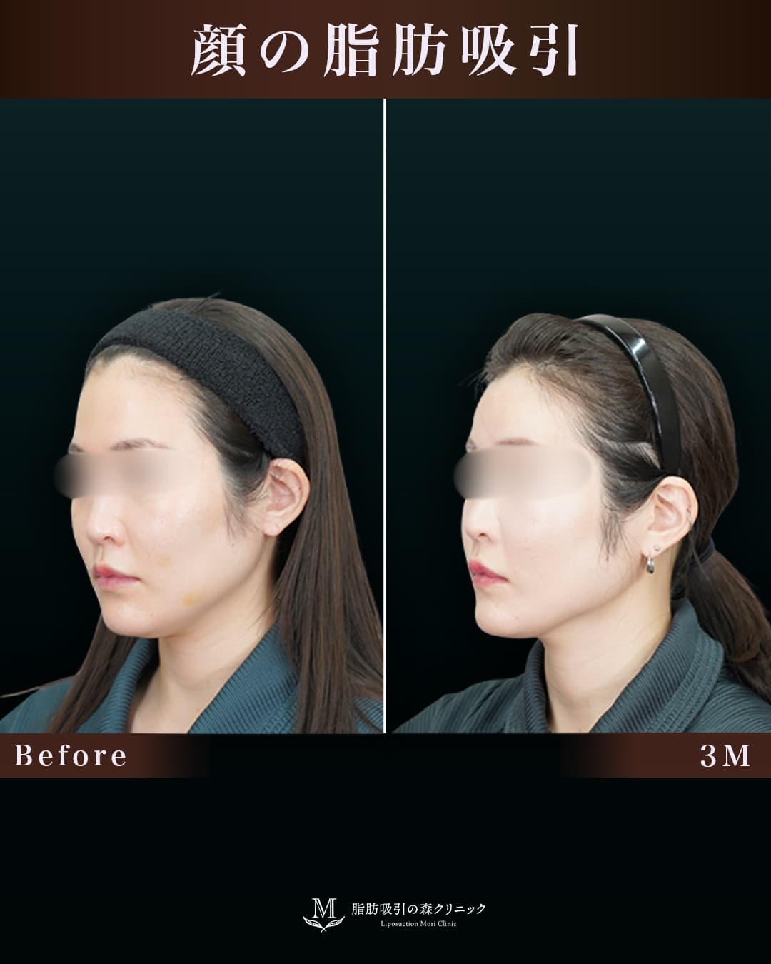 159㎝60㎏30代 頬+顎下 術後3か月の症例写真