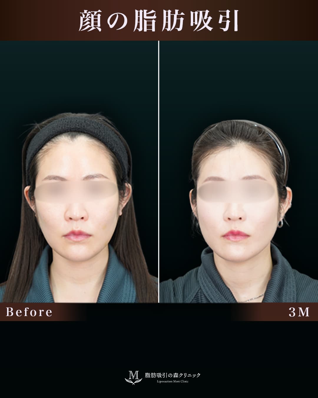 159㎝60㎏30代 頬+顎下 術後3か月の症例写真