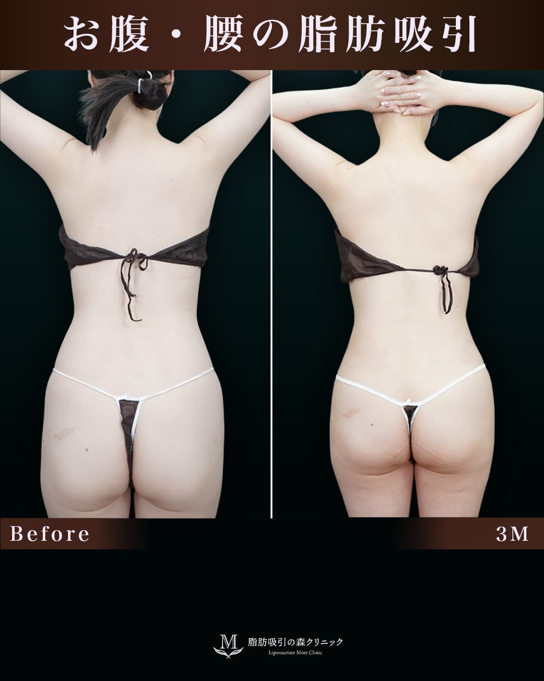 158㎝46㎏30代 側腹・下腹・腰 術後3か月の症例写真