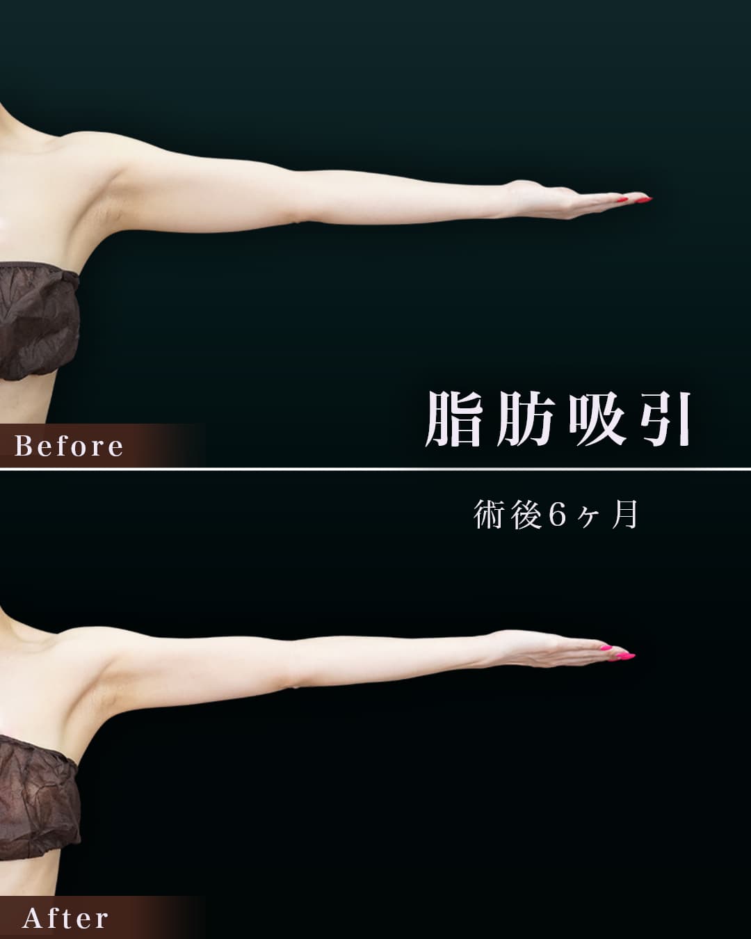 154㎝42㎏30代 上腕・肩 術後6か月の症例写真