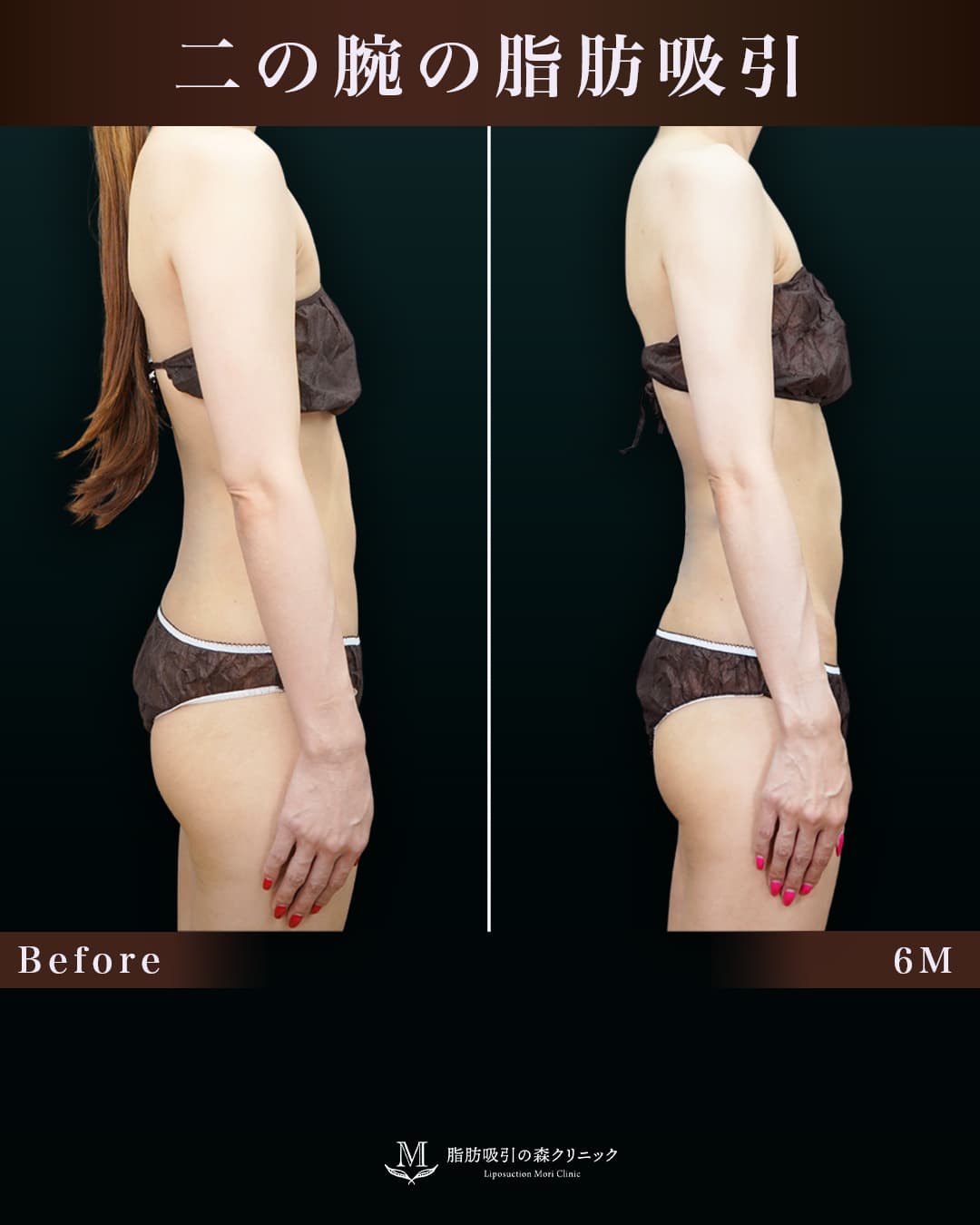 154㎝42㎏30代 上腕・肩 術後6か月の症例写真