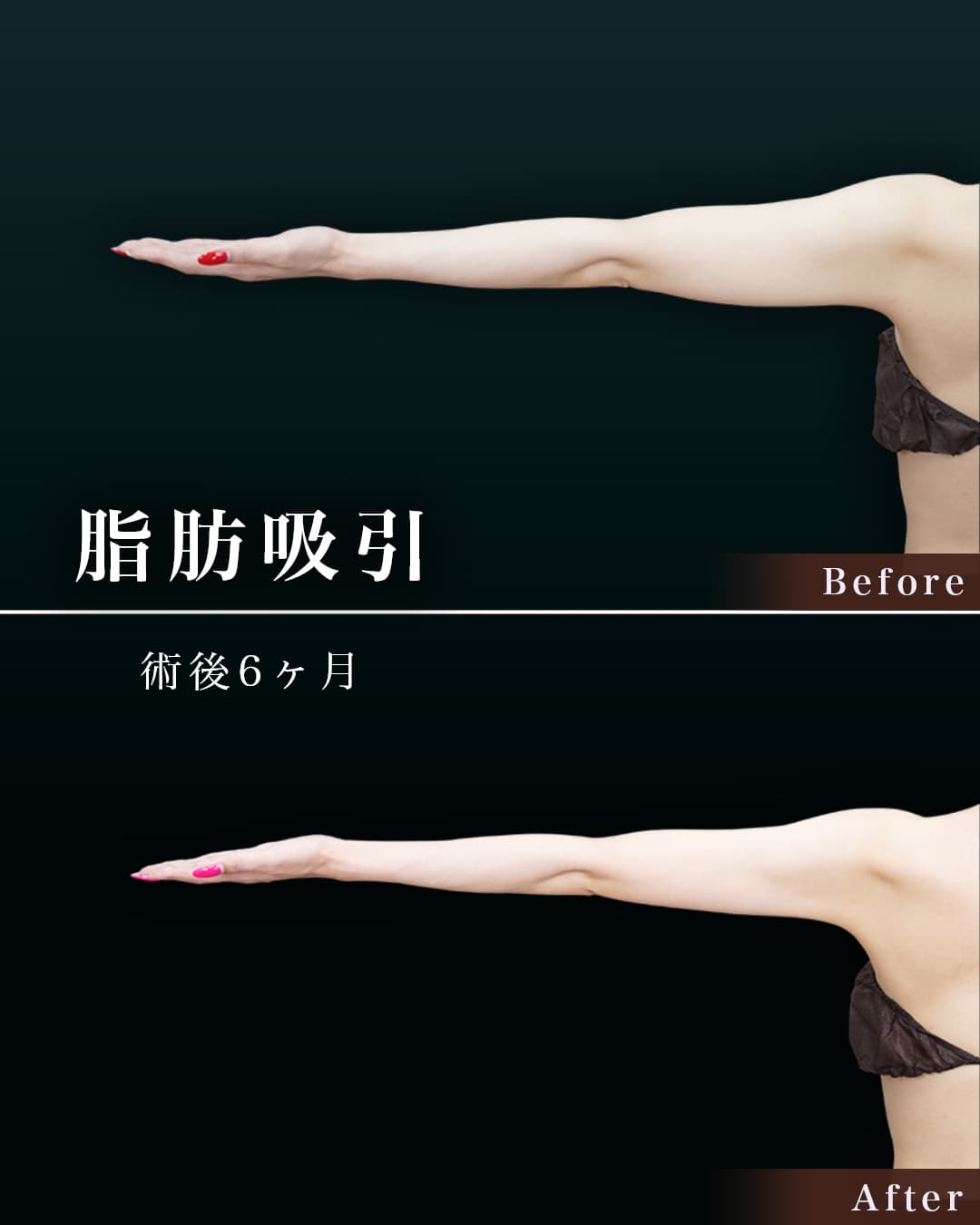 154㎝42㎏30代 上腕・肩 術後6か月の症例写真