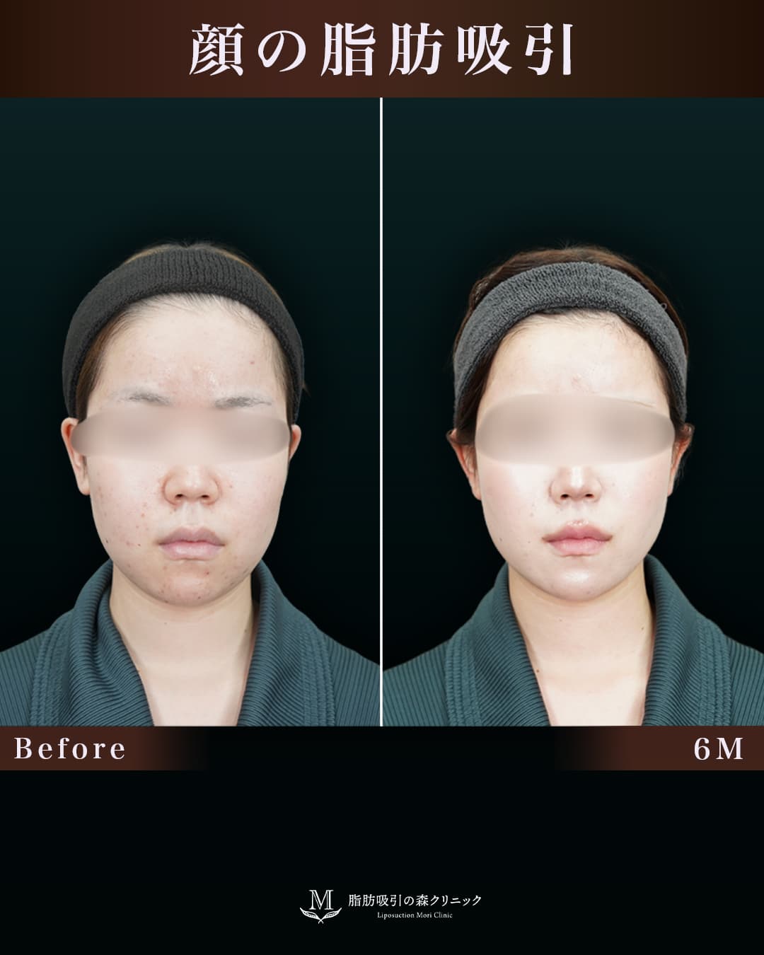160㎝55㎏10代 頬・顎下 術後6か月の症例写真