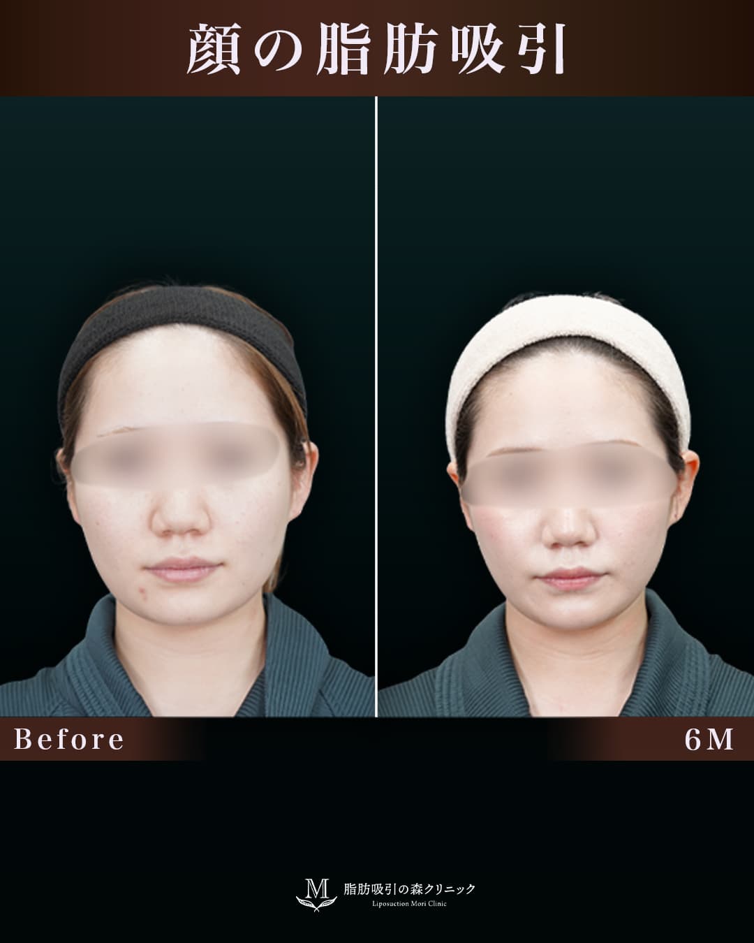 161㎝59㎏10代 頬・顎下 術後6か月の症例写真