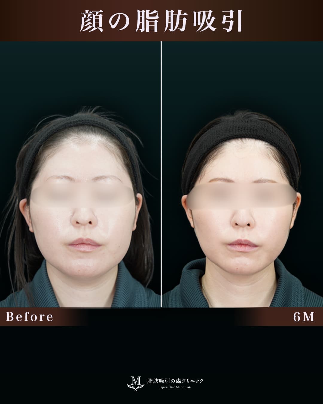 160㎝57㎏30代 頬・顎下 術後6か月の症例写真