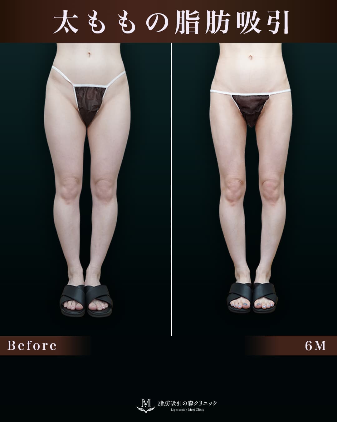 150㎝45㎏30代 大腿全周・膝・臀部 術後6か月の症例写真