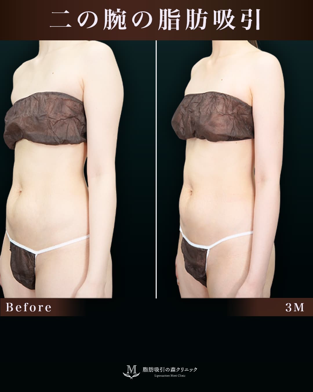 162㎝50㎏30代 上腕・肩、付け根 術後3か月の症例写真