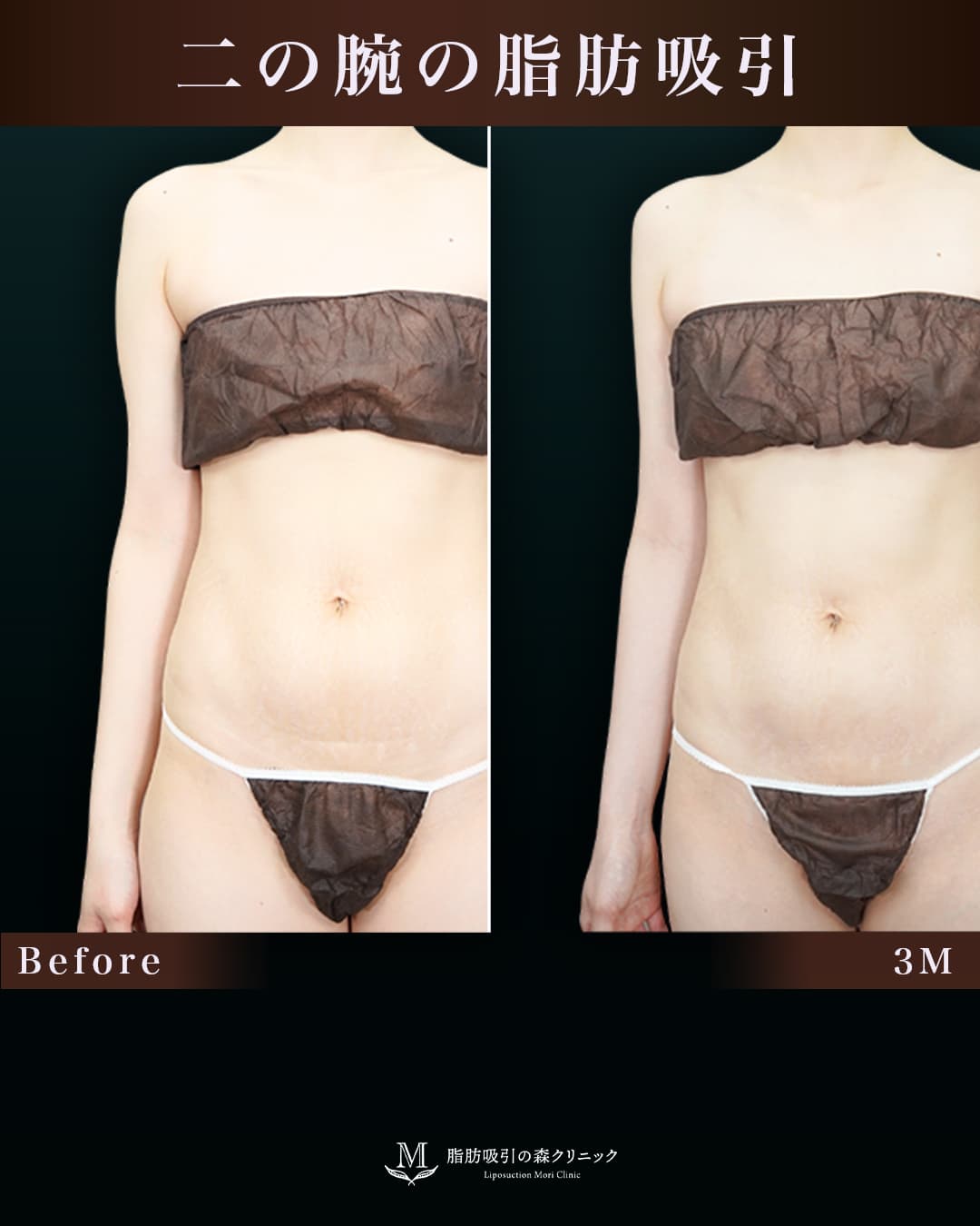 162㎝50㎏30代 上腕・肩、付け根 術後3か月の症例写真