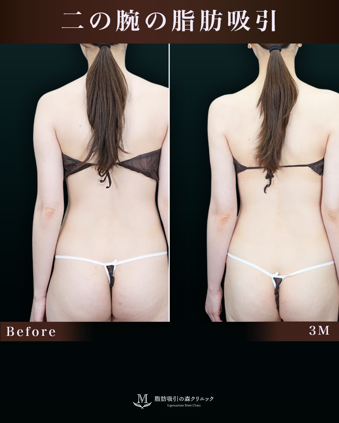 162㎝50㎏30代 上腕・肩、付け根 術後3か月の症例写真
