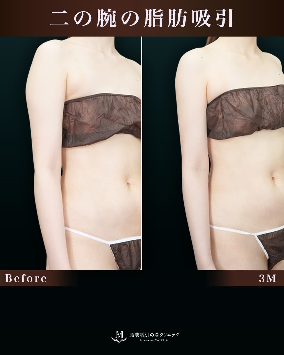 162㎝50㎏30代 上腕・肩、付け根 術後3か月の症例写真