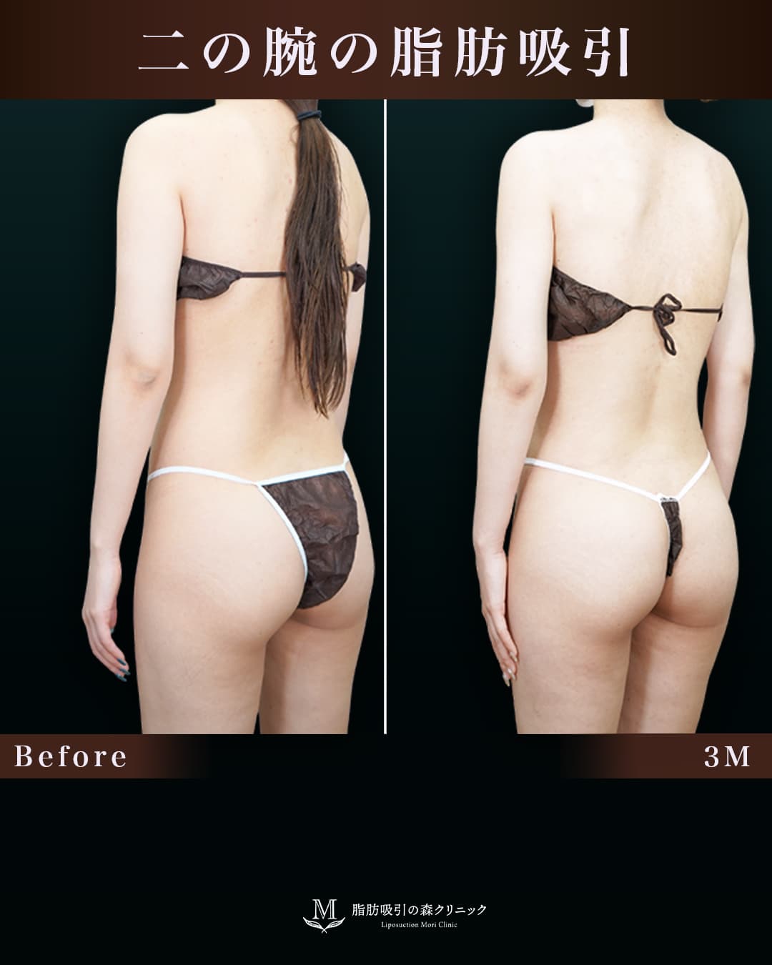 腕が細くなり華奢なBodyに見えるように!の症例写真