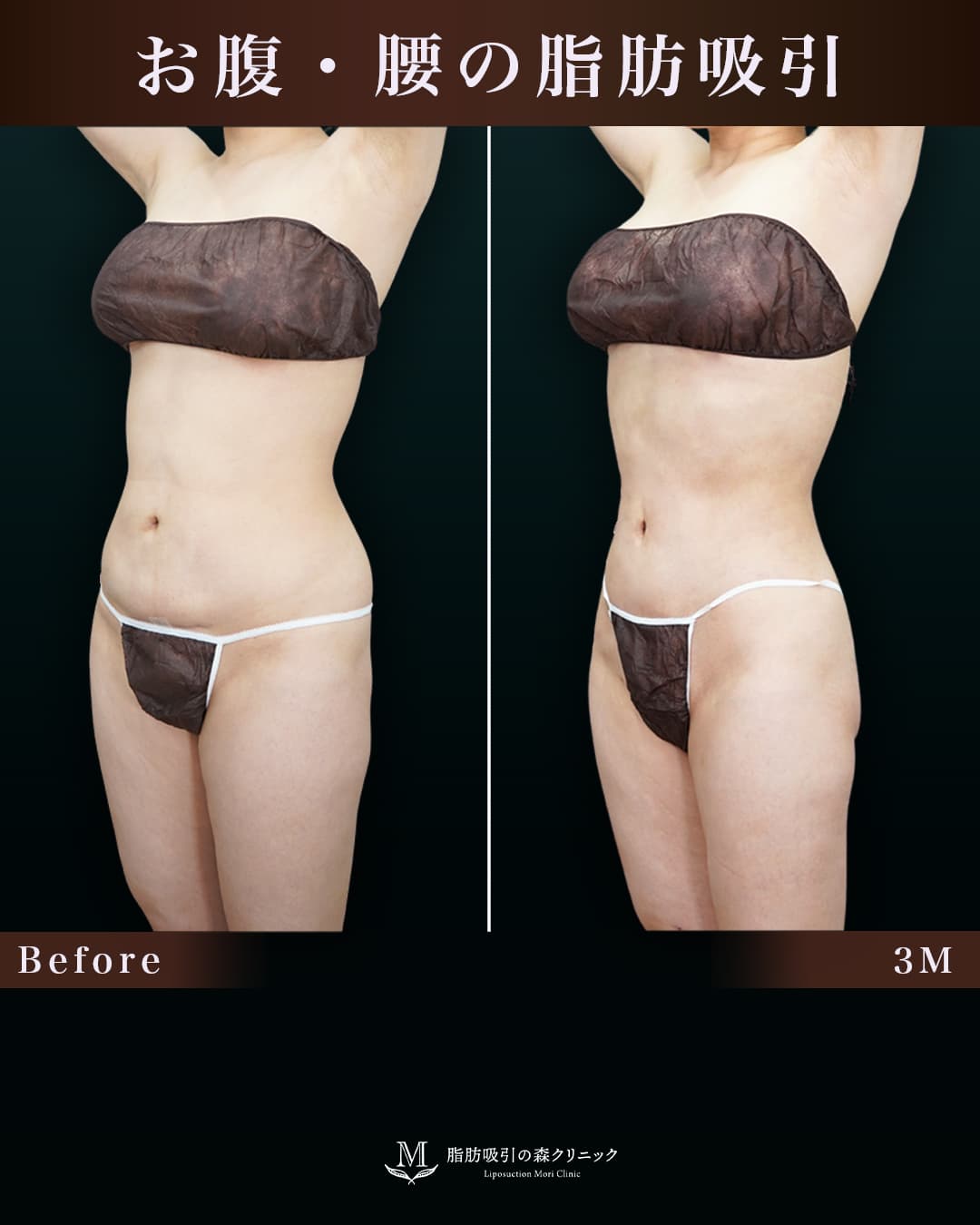 取り残しと凹付きを改善し、より綺麗なクビレに変化!の症例写真