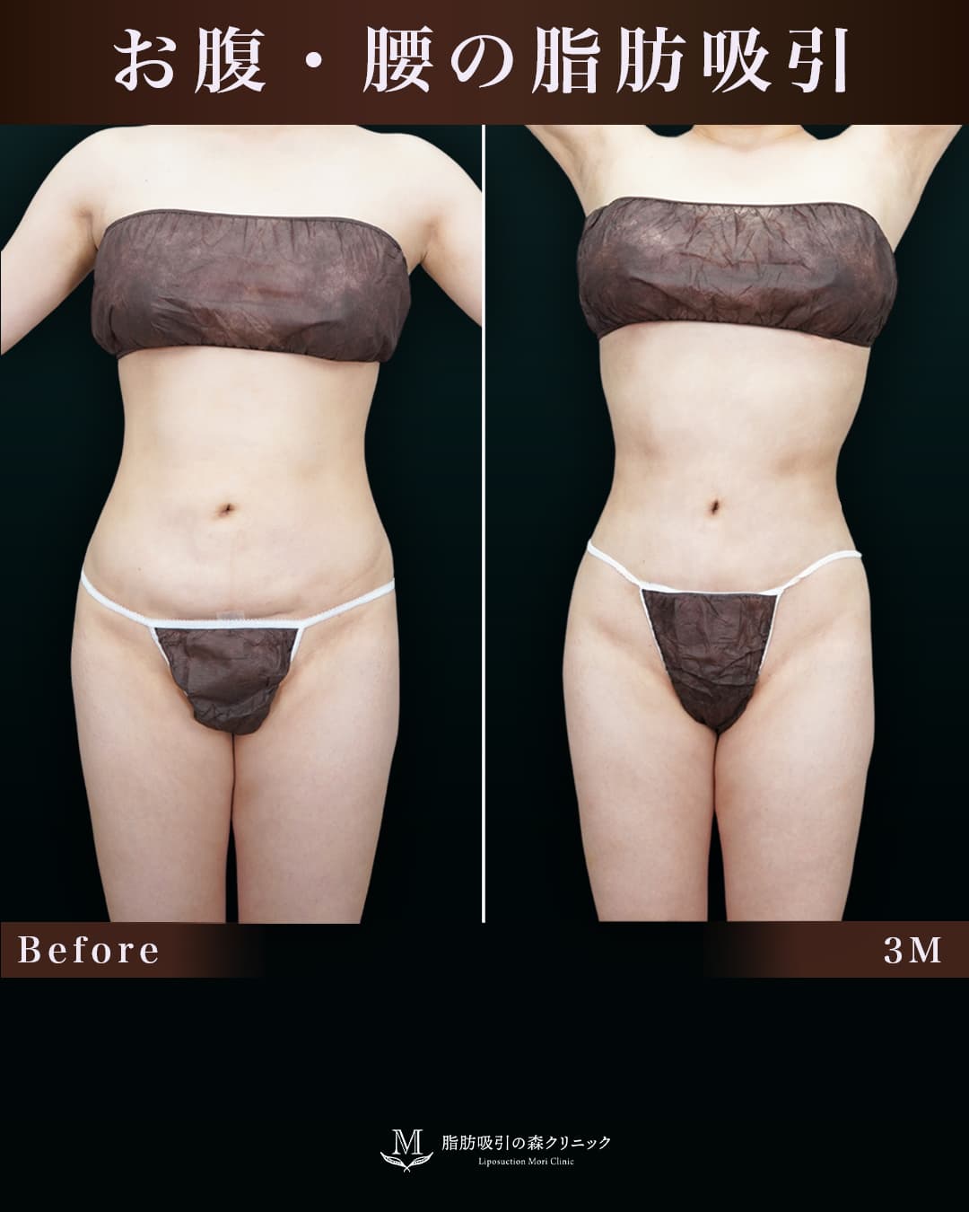取り残しと凹付きを改善し、より綺麗なクビレに変化!の症例写真
