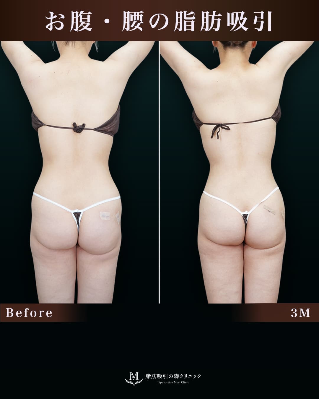 取り残しと凹付きを改善し、より綺麗なクビレに変化!の症例写真