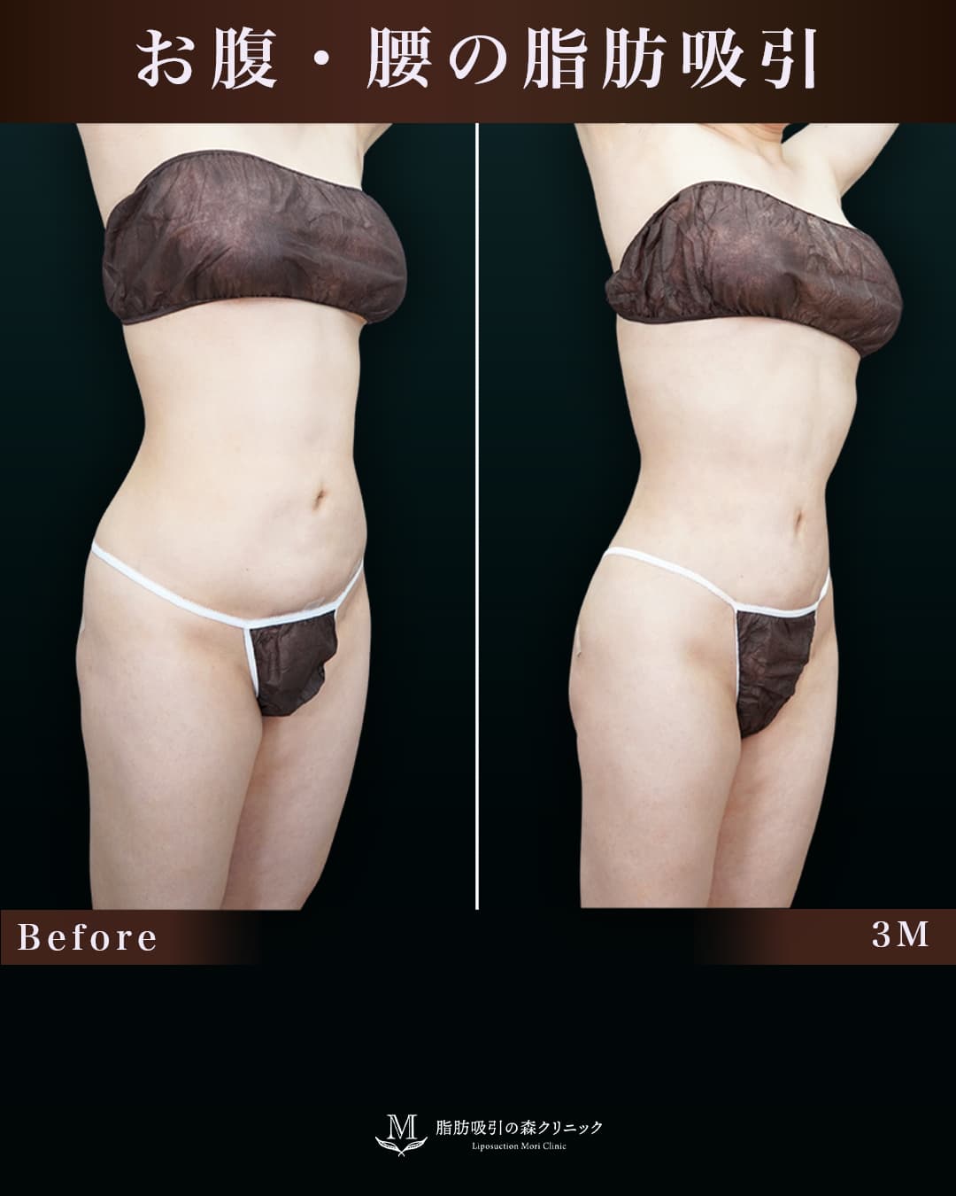 取り残しと凹付きを改善し、より綺麗なクビレに変化!の症例写真