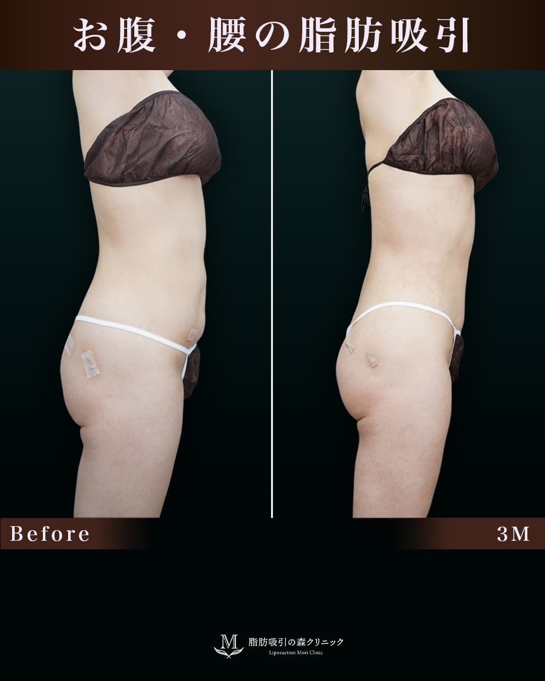 取り残しと凹付きを改善し、より綺麗なクビレに変化!の症例写真