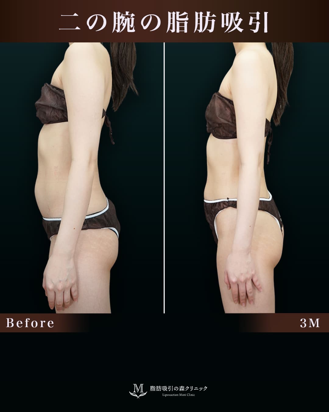 脂肪吸引して腕が綺麗と褒められました!の症例写真