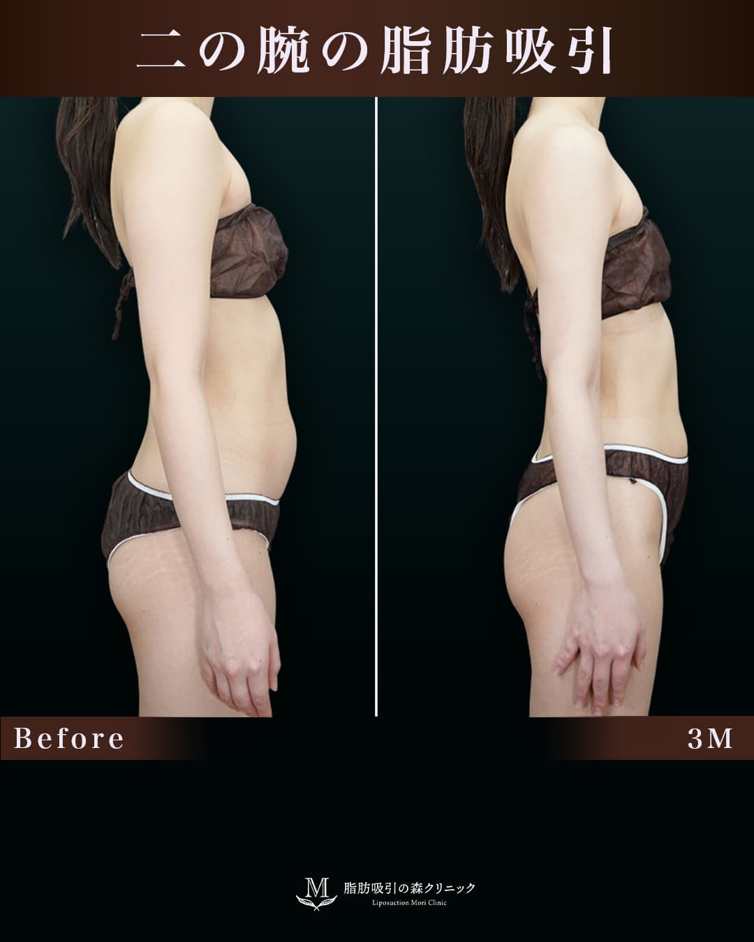 脂肪吸引して腕が綺麗と褒められました!の症例写真