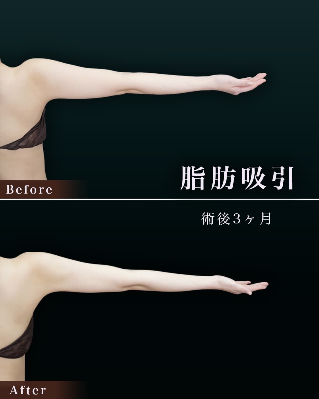 脂肪吸引して腕が綺麗と褒められました!の症例写真