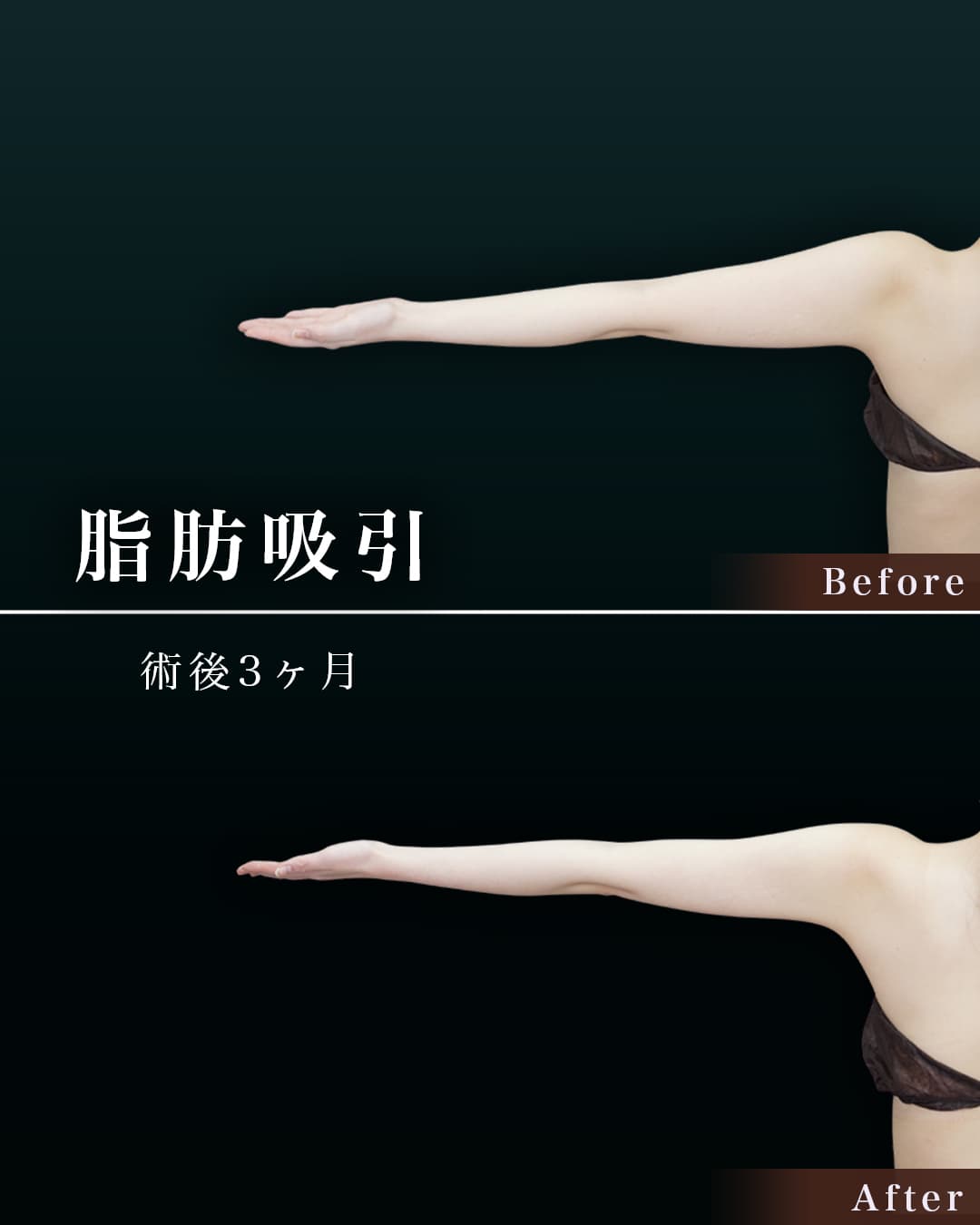 脂肪吸引して腕が綺麗と褒められました!の症例写真