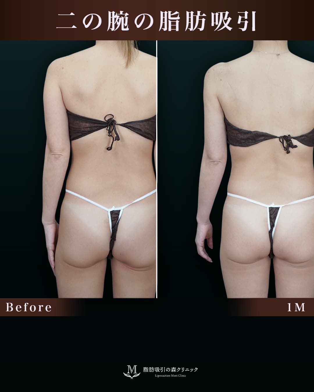 腕周りも吸引することでより綺麗に!の症例写真