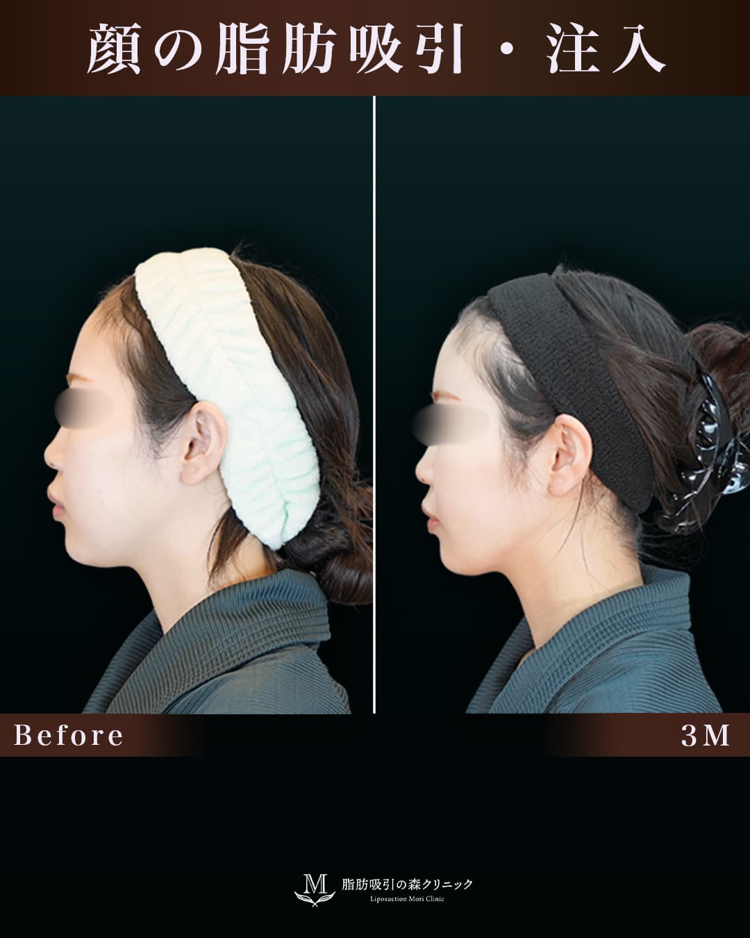 脂肪注入で自然な丸みのあるおでこに!の症例写真
